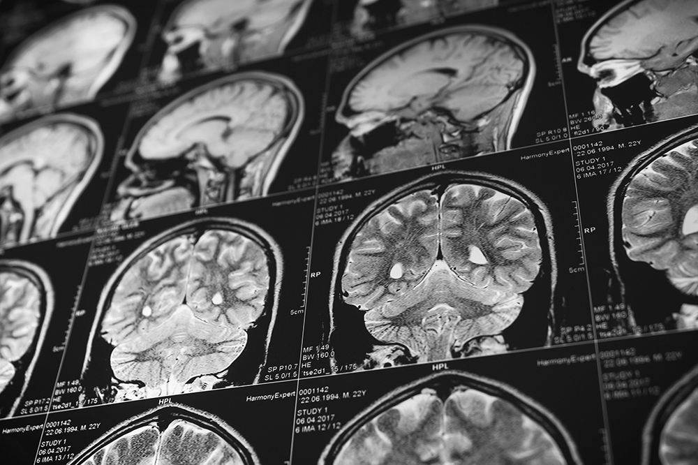 Featured - Leptomeningeal Disease: How is it Different from Brain Metastasis and How is it Treated?