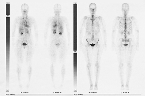 Featured - Different Types of Imaging Scans: Bone Scans